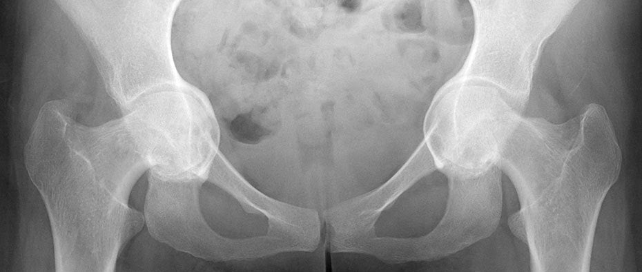 Artrosis de Cadera: Tres síntomas a tomar en cuenta